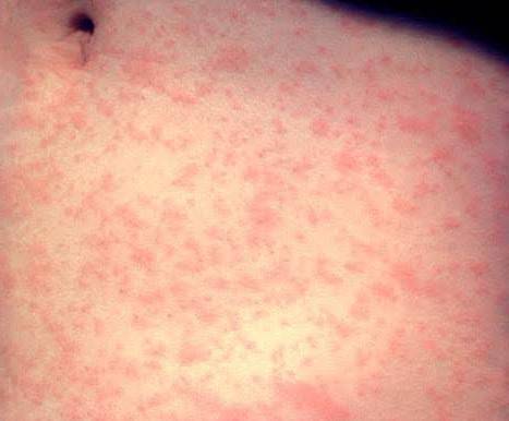 measles2.jpg measles2.jpg
